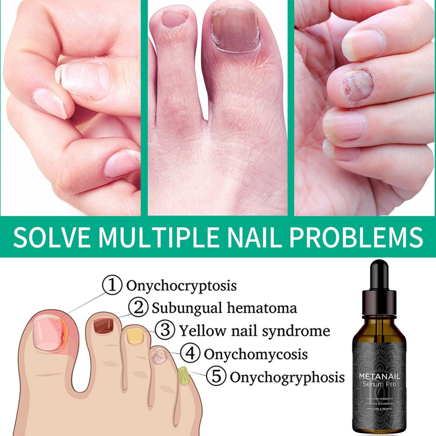2 Pack-Metanail Toenail Treatment Nail Growth Treatment for Toenail Treatment Extra Strength for Repairing Damaged and Discolored Nails